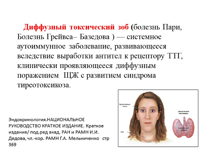 Диффузный токсический зоб (болезнь Пари, Болезнь Грейвса– Базедова ) — системное аутоиммунное заболевание, развивающееся